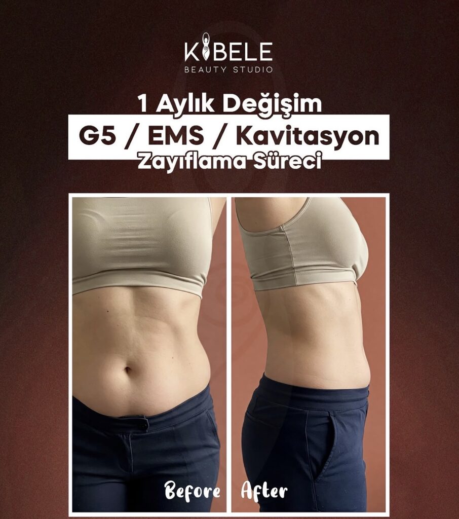 Kibele Beauty Studio Ankara Balgat G5 EMS kavitasyon bölgesel incelme uygulama süreci öncesi sonrası görseli